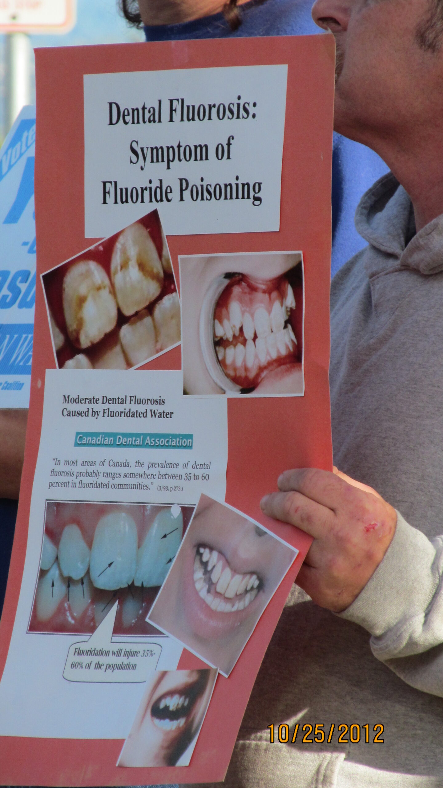 Fluoridation May Be Doing More Dental Harm Than Good, Researchers Report, Using US Statistics
